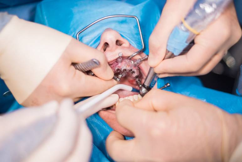 What to Expect During Your Visit to a Dental Surgeon