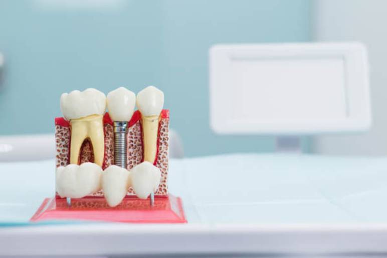 Why Choose Dental Implants?