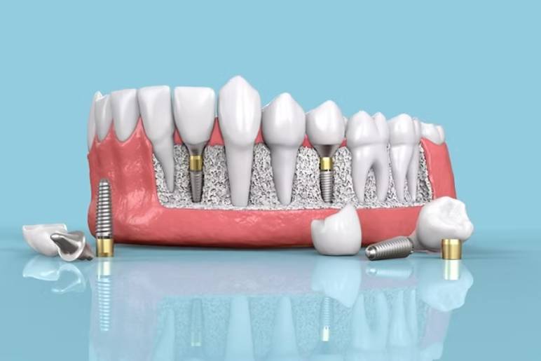 Finding the Best Dental Implant Services in Kolkata