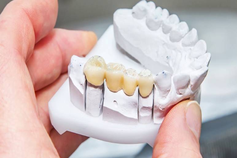 The Dental Implant Procedure – Step-by-Step Guide