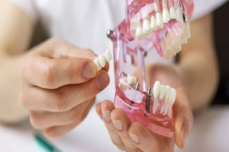 Why Choose Us for Your Dental Implant Needs?